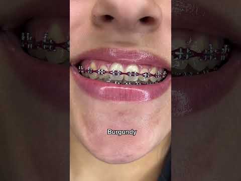 Best Braces Colors for Whiter Looking Teeth Part 1